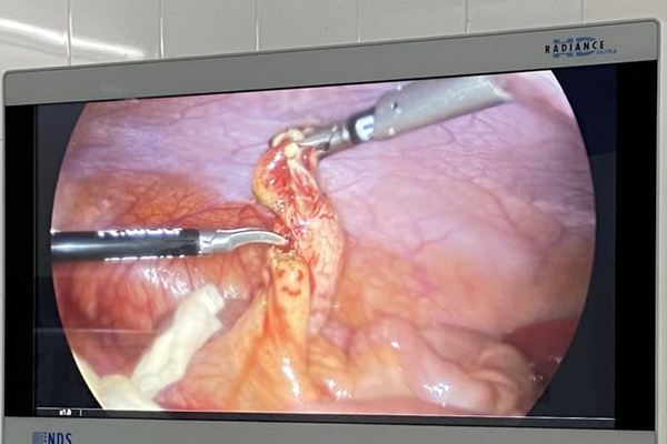 Bệnh viện Đa khoa thành phố Ngã Bảy đã điều trị thành công một trường hợp bệnh "Viêm ruột thừa ở hố chậu trái"